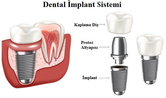 implant